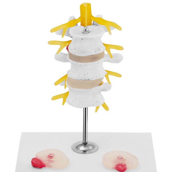 Mugurkaula jostas mugurkaula 3D anatomiskais modelis ar trūci 3-5