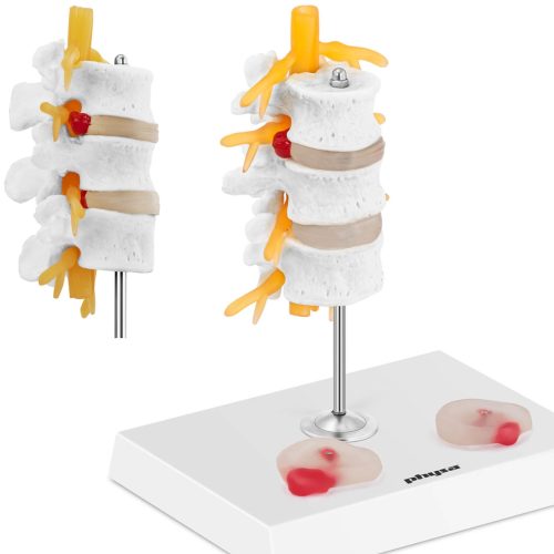 Mugurkaula jostas mugurkaula 3D anatomiskais modelis ar trūci 3-5